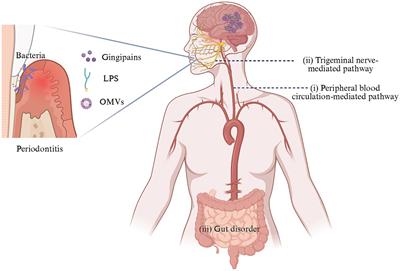 The oral-brain axis: can periodontal pathogens trigger the onset and progression of Alzheimer’s disease?
